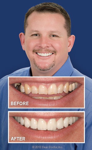 A mans teeth before and after